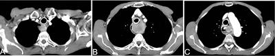 Arterial Infusion Chemotherapy for Neoplastic Esophagogastric Anastomotic Strictures After Esophagectomy